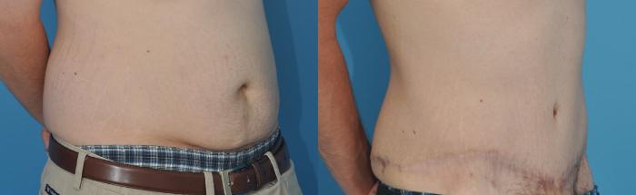 Before & After Abdominoplasty/Tummy Tuck Case 22 View #2 View in North Shore, IL