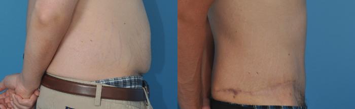 Before & After Abdominoplasty/Tummy Tuck Case 22 View #3 View in North Shore, IL