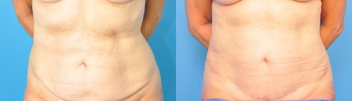 Before & After Abdominoplasty/Tummy Tuck Case 220 View #1 View in North Shore, IL