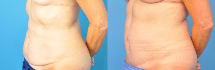 Before & After Abdominoplasty/Tummy Tuck Case 220 View #2 View in North Shore, IL