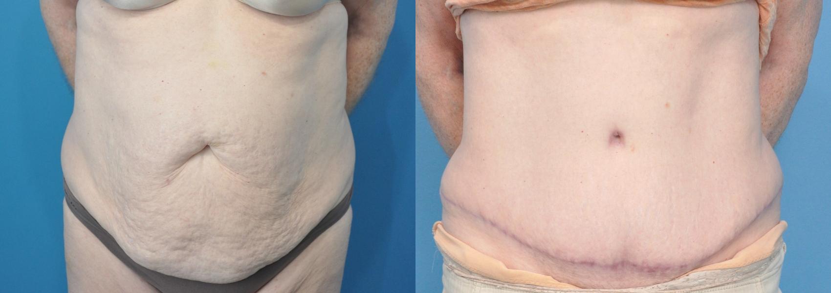 Before & After Abdominoplasty/Tummy Tuck Case 221 View #1 View in Northbrook, IL