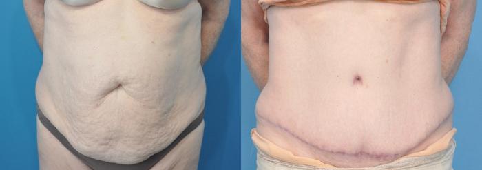 Before & After Abdominoplasty/Tummy Tuck Case 221 View #1 View in North Shore, IL