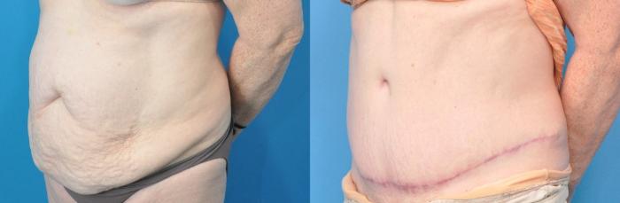 Before & After Abdominoplasty/Tummy Tuck Case 221 View #2 View in North Shore, IL