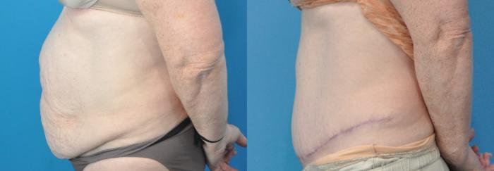 Before & After Abdominoplasty/Tummy Tuck Case 221 View #3 View in North Shore, IL