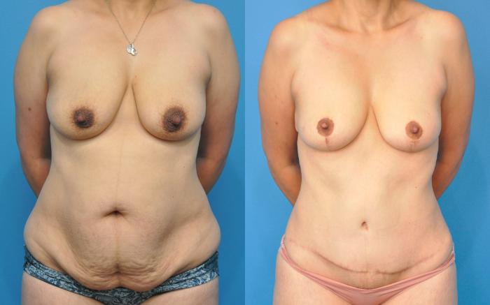 Before & After Abdominoplasty/Tummy Tuck Case 222 View #1 View in Northbrook, IL
