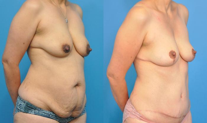 Before & After Abdominoplasty/Tummy Tuck Case 222 View #2 View in Northbrook, IL
