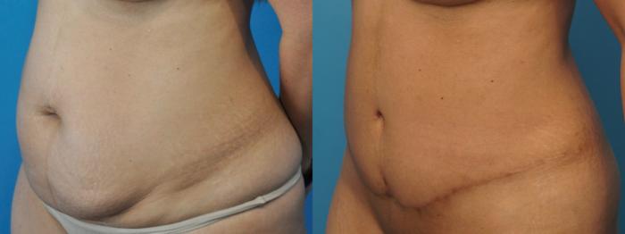 Before & After Abdominoplasty/Tummy Tuck Case 226 View #2 View in North Shore, IL