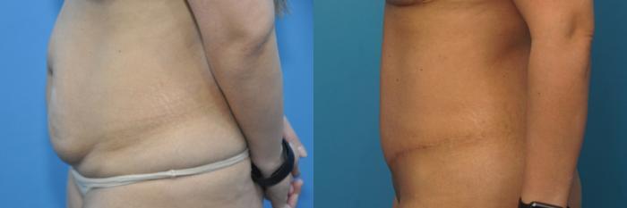 Before & After Abdominoplasty/Tummy Tuck Case 226 View #3 View in North Shore, IL