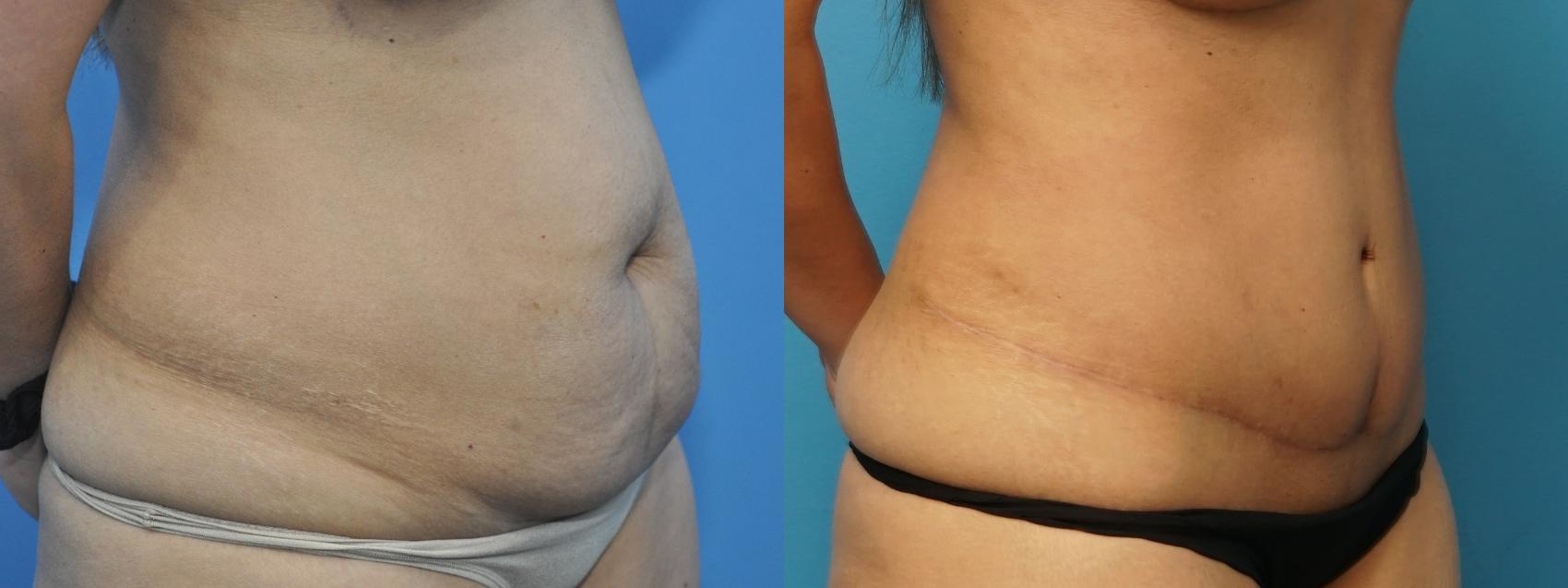 Before & After Abdominoplasty/Tummy Tuck Case 226 View #4 View in Northbrook, IL