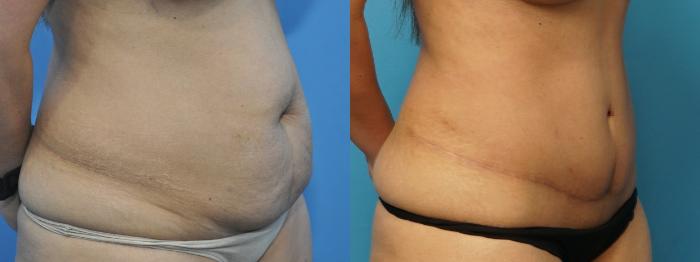 Before & After Abdominoplasty/Tummy Tuck Case 226 View #4 View in North Shore, IL