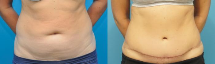 Before & After Abdominoplasty/Tummy Tuck Case 235 View #1 View in North Shore, IL