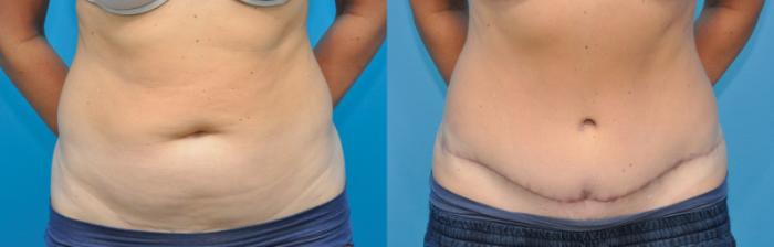Before & After Abdominoplasty/Tummy Tuck Case 235 View #2 View in North Shore, IL