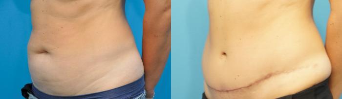 Before & After Abdominoplasty/Tummy Tuck Case 235 View #3 View in North Shore, IL