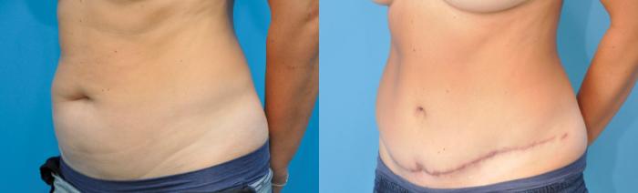 Before & After Abdominoplasty/Tummy Tuck Case 235 View #4 View in North Shore, IL