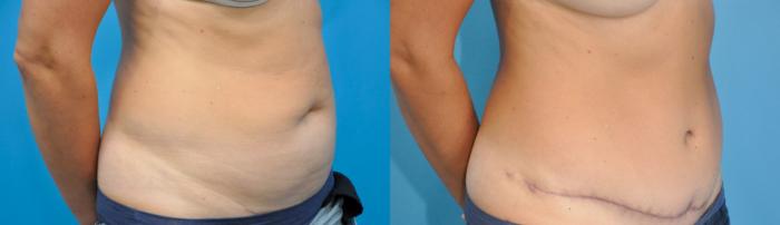 Before & After Abdominoplasty/Tummy Tuck Case 235 View #5 View in North Shore, IL