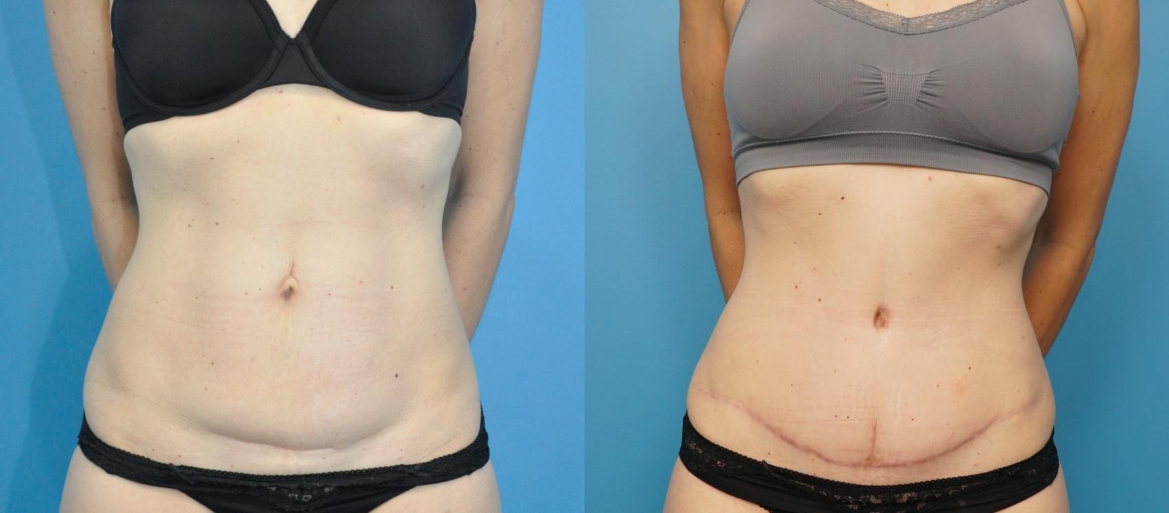 Before & After Abdominoplasty/Tummy Tuck Case 236 View #1 View in Northbrook, IL