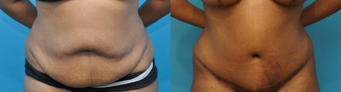 Before & After Abdominoplasty/Tummy Tuck Case 238 View #1 View in Northbrook, IL