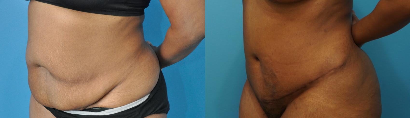 Before & After Abdominoplasty/Tummy Tuck Case 238 View #2 View in North Shore, IL