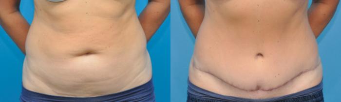 Before & After Abdominoplasty/Tummy Tuck Case 242 View #1 View in North Shore, IL