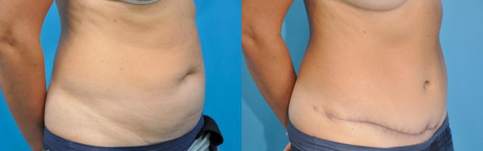 Before & After Abdominoplasty/Tummy Tuck Case 242 View #2 View in North Shore, IL