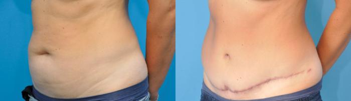 Before & After Abdominoplasty/Tummy Tuck Case 242 View #3 View in North Shore, IL