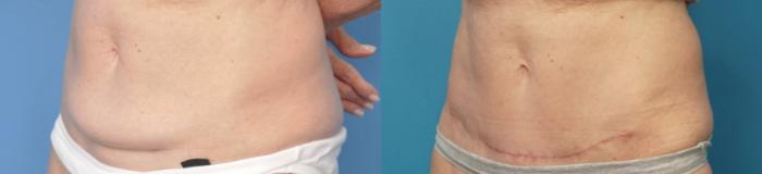 Before & After Abdominoplasty/Tummy Tuck Case 249 View #1 View in North Shore, IL