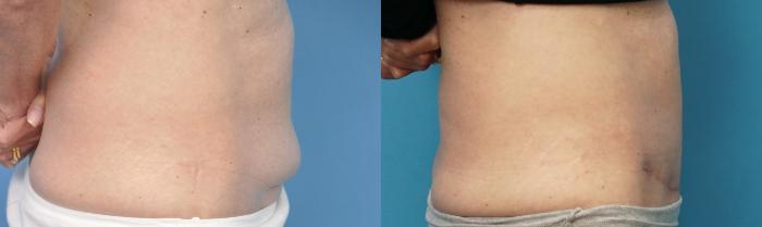 Before & After Abdominoplasty/Tummy Tuck Case 249 View #2 View in North Shore, IL