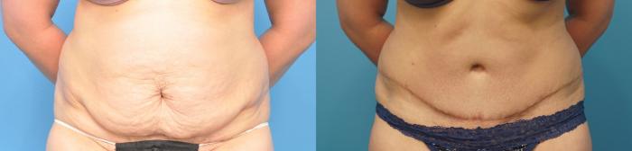 Before & After Abdominoplasty/Tummy Tuck Case 254 Front View in North Shore, IL
