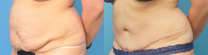 Before & After Abdominoplasty/Tummy Tuck Case 254 Left Oblique View in North Shore, IL