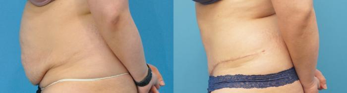 Before & After Abdominoplasty/Tummy Tuck Case 254 Left Side View in North Shore, IL
