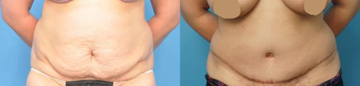 Before & After Abdominoplasty/Tummy Tuck Case 254 View #1 View in North Shore, IL