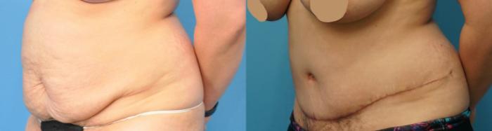 Before & After Abdominoplasty/Tummy Tuck Case 254 View #2 View in North Shore, IL