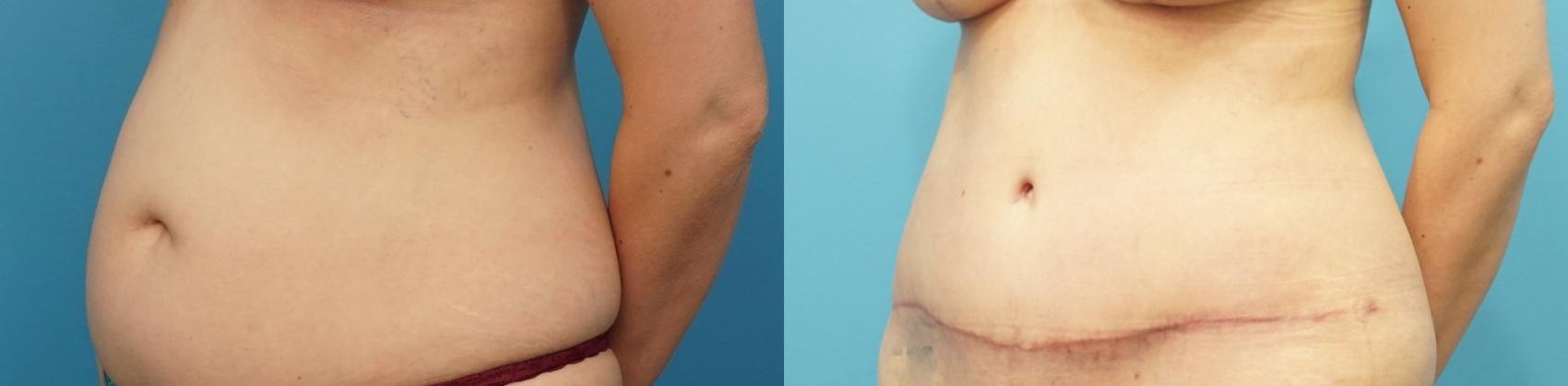 Before & After Abdominoplasty/Tummy Tuck Case 263 View #1 View in North Shore, IL