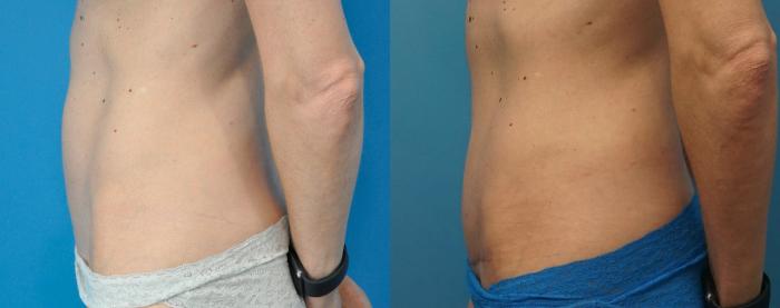 Before & After Abdominoplasty/Tummy Tuck Case 265 View #1 View in North Shore, IL