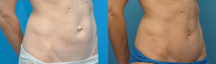 Before & After Abdominoplasty/Tummy Tuck Case 265 View #2 View in North Shore, IL
