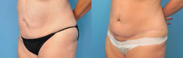 Before & After Abdominoplasty/Tummy Tuck Case 269 Front View in North Shore, IL
