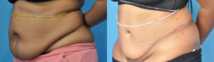 Before & After Liposuction Case 277 Left Oblique View in Northbrook, IL