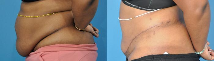 Before & After Liposuction Case 277 Left Side View in North Shore, IL