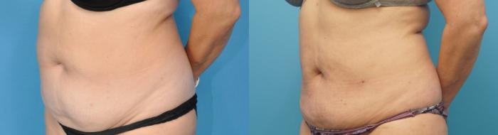 Before & After Liposuction Case 279 Front View in Northbrook, IL