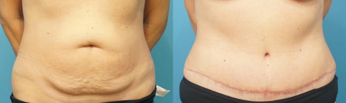 Before & After Liposuction Case 281 Front View in Northbrook, IL