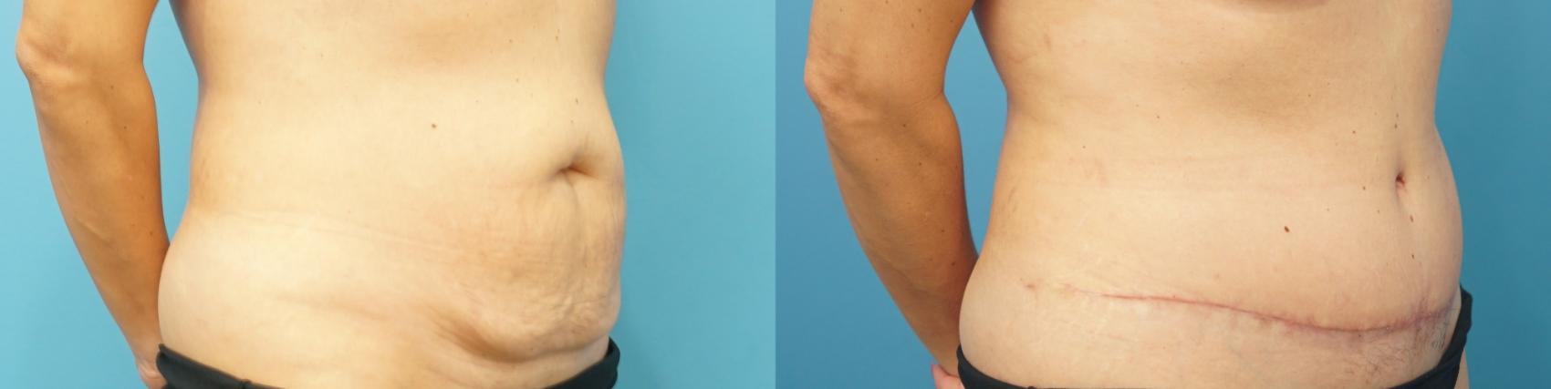 Before & After Abdominoplasty/Tummy Tuck Case 281 Right Oblique View in Northbrook, IL