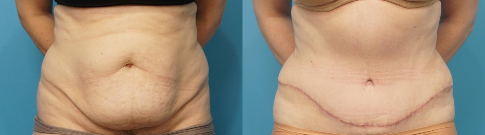 Before & After Liposuction Case 288 Front View in Northbrook, IL