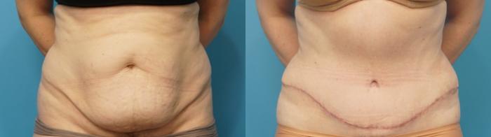 Before & After Liposuction Case 288 Front View in North Shore, IL