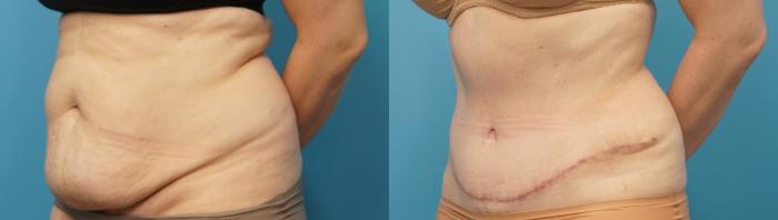 Before & After Abdominoplasty/Tummy Tuck Case 288 Left Oblique View in Northbrook, IL