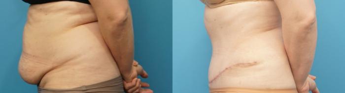 Before & After Abdominoplasty/Tummy Tuck Case 288 Left Side View in Northbrook, IL