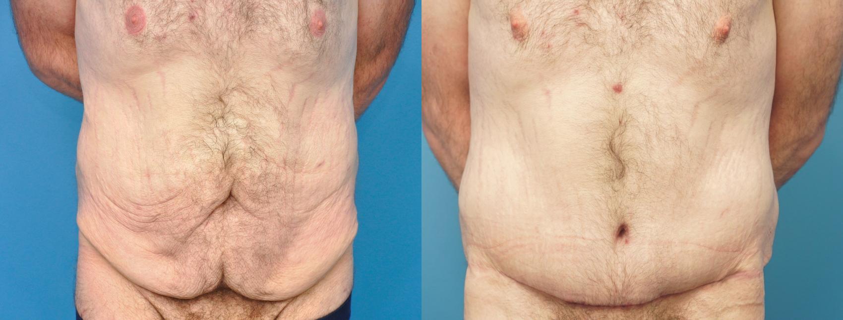 Before & After Abdominoplasty/Tummy Tuck Case 291 Front View in North Shore, IL