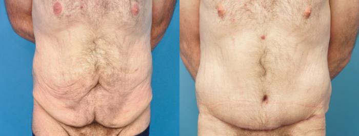 Before & After Abdominoplasty/Tummy Tuck Case 291 Front View in Northbrook, IL