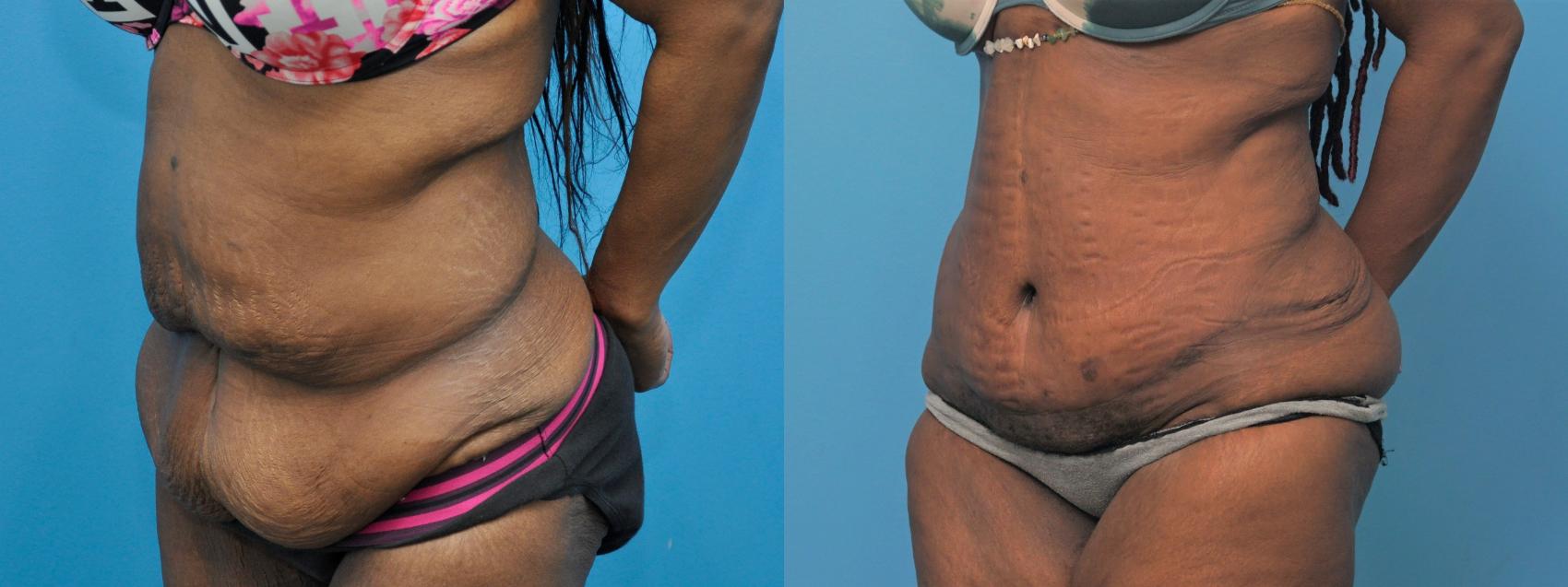 Before & After Abdominoplasty/Tummy Tuck Case 305 View #1 View in Northbrook, IL