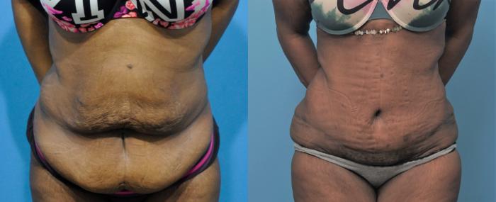Before & After Abdominoplasty/Tummy Tuck Case 305 View #2 View in Northbrook, IL