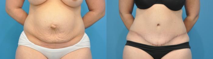 Before & After Abdominoplasty/Tummy Tuck Case 308 View #1 View in North Shore, IL